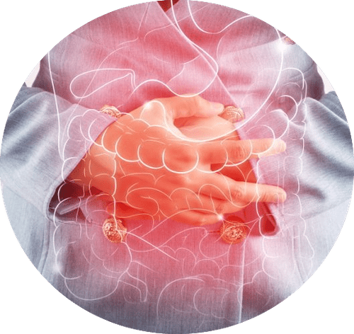 Irritable Bowel (IBS)