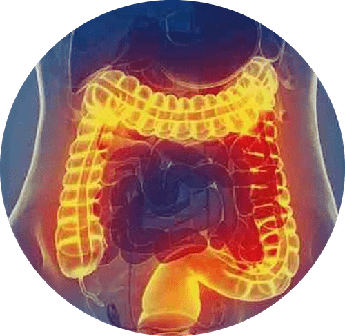 Diverticulitis